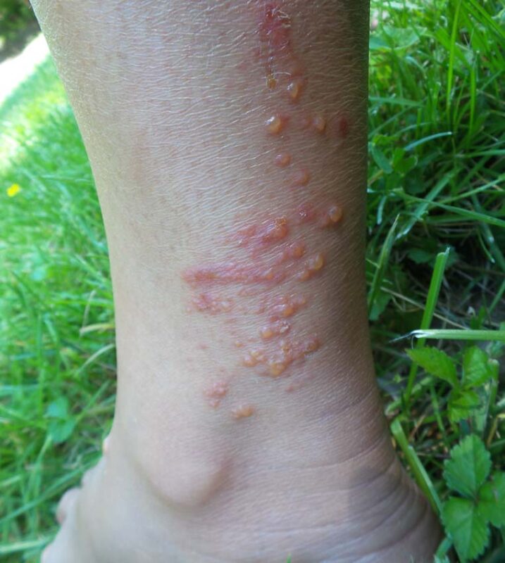 guide to poisonous weeds poison ivy rash